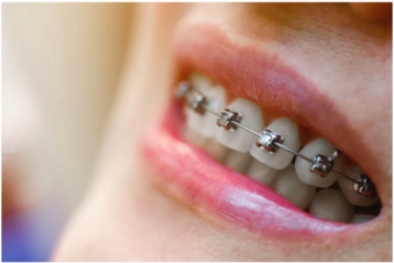 Self-Ligating Braces