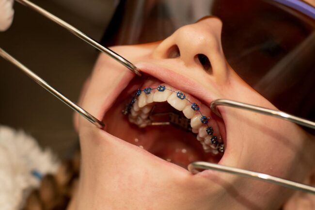 7 Signs You May Need Orthodontic Treatment إنفزلاين في الرياض