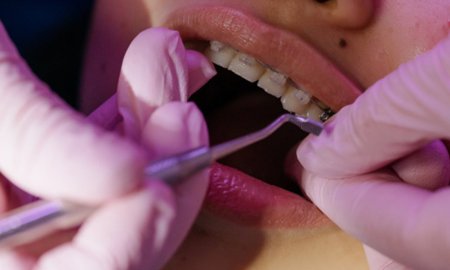 Clear Aligners vs Traditional Braces Pros and Cons Explained (1) clear aligners in Riyadh
