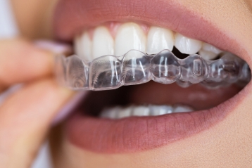 How Clear Aligners Work