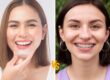 Invisalign in Riyadh