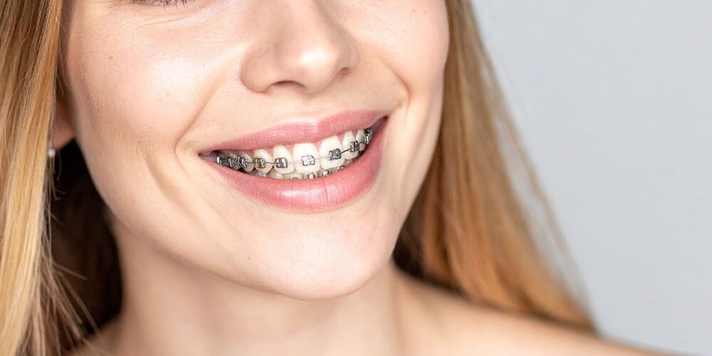 Braces Care Guide How to Maintain Oral Hygiene During Treatment clear braces