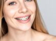 clear braces