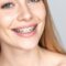 clear braces