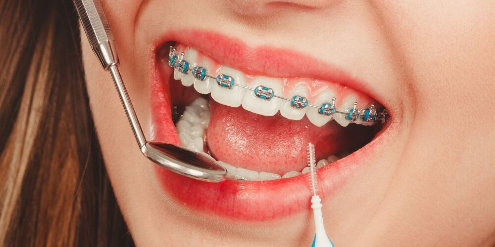 clear braces