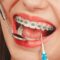 clear braces