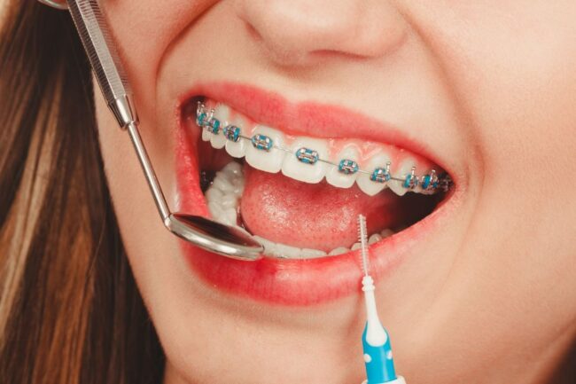 How to Choose the Right Orthodontist for Your Smile Transformation clear braces